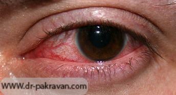 قرمزی چشم ناشی از استفاده از لنز تماسی